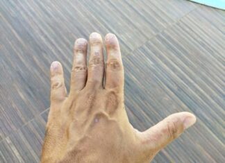 Alérgicos tem menos chances de contrair Covid-19