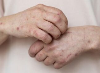 Feira de Santana registrou 10 casos de varíola dos macacos em 2022