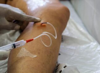 A cada dia, 145 mulheres são internadas para tratar varizes