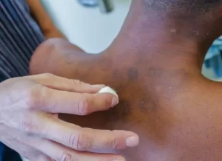 Novos casos de hanseníase aumentaram 5% de janeiro a novembro de 2023