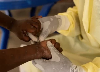 Mpox: conheça sintomas e tire principais dúvidas sobre a doença