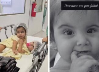 Gêmea Siamesa Morre Após Cirurgia De Separação Em Goiânia