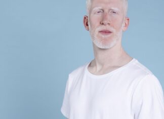 Sancionada lei que cria política de proteção a pessoas com albinismo