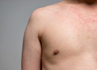 7 respostas para se proteger contra o sarampo, que volta a preocupar