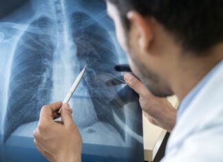 Entenda o que é pneumonia silenciosa, que tem alertado autoridades de saúde