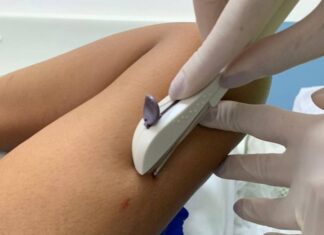 Saúde Amplia Capacitação Para Implante Contraceptivo No SUS