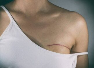 Nova Lei Garante Fisioterapia No SUS A Pacientes Que Retirarem A Mama