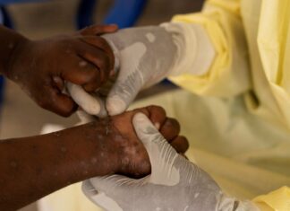 Brasil registra 88 casos de Mpox em 2026; saiba como evitar a doença