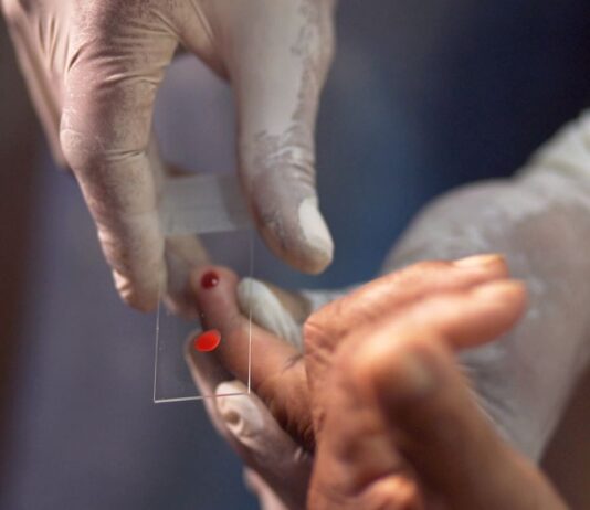 SUS começa a usar novo tratamento contra a malária em crianças