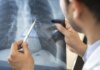 Câncer de pulmão: pesquisa aponta frequência de mutação do gene EGFR