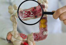 Em 13 anos, doença inflamatória intestinal cresce 5 vezes no Brasil