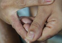 Dermatite atópica impacta pele, sono e autoestima: saiba como tratar