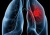 Saiba o que é adenocarcinoma pulmonar, câncer que atinge o Papa Leão